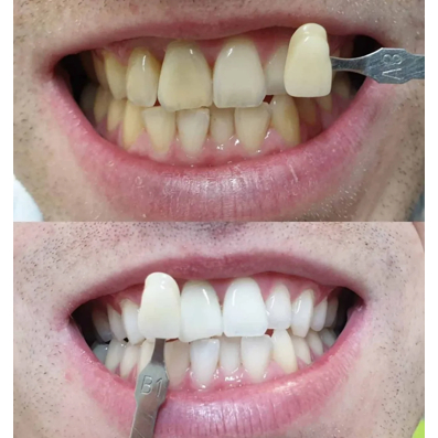 Maarc Blitz White Bleaching Whitening Tooth Kit | One Set Bleaching Gigi - Gambar 4