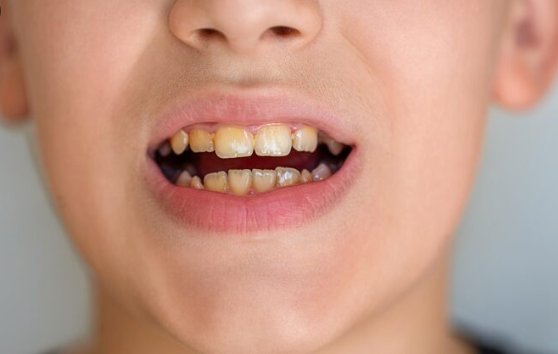 mengatasi gigi kuning